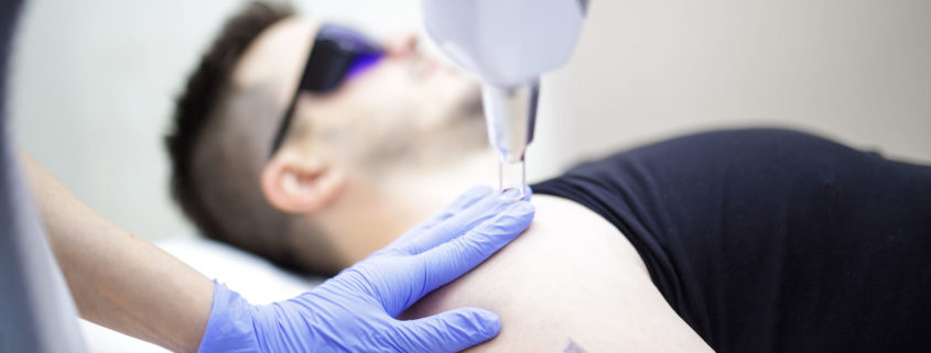 Skidanje tetovaže laserom